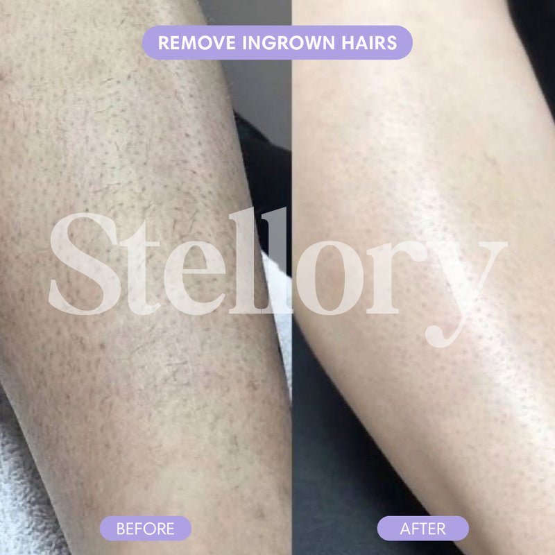 Stellory® Crystal Hair Eraser