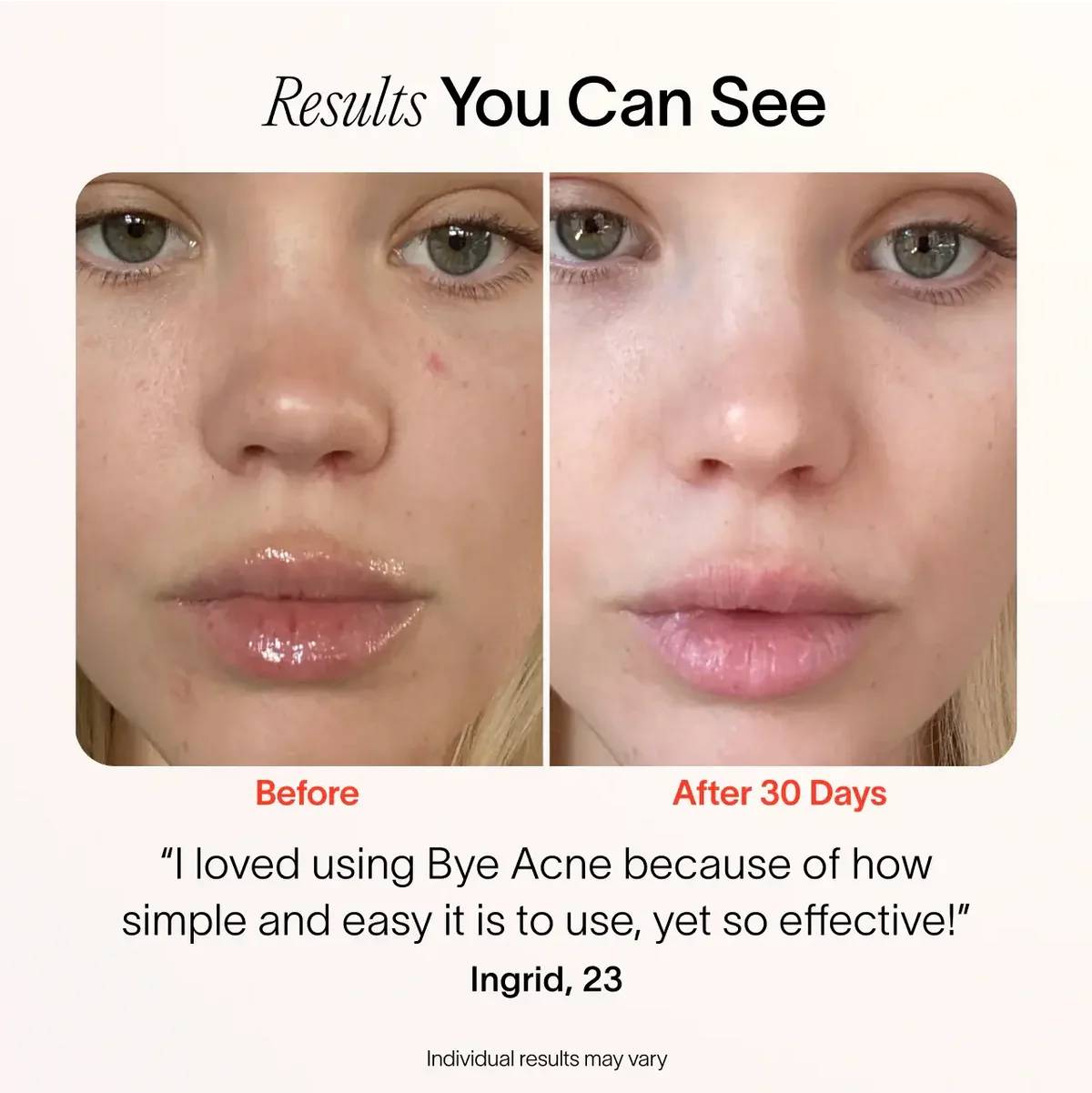 (VIP) Stellory® 3-Minute Acne Spot Treatment