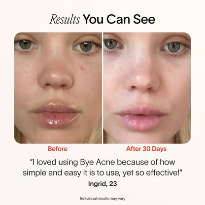 (VIP) Stellory® 3-Minute Acne Spot Treatment