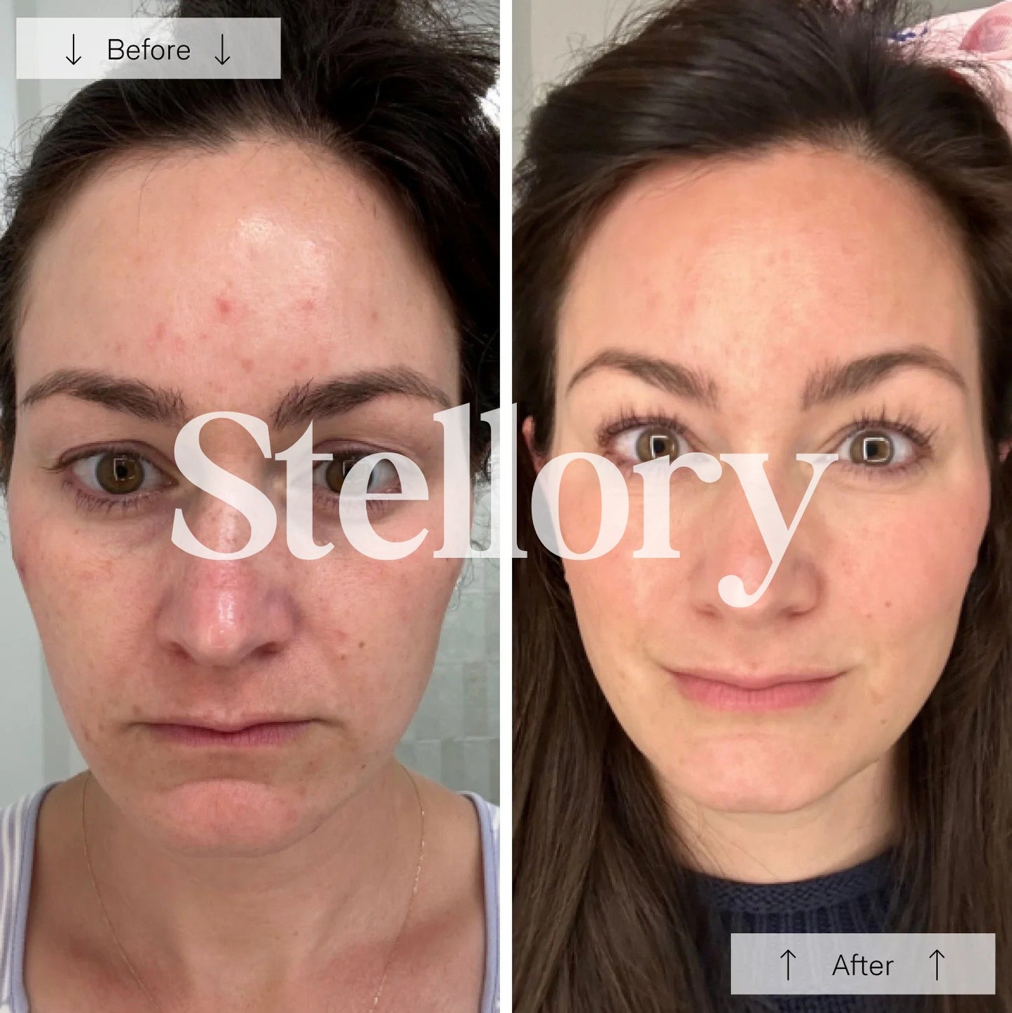 (VIP) Stellory® Red Light Therapy Mask - Rejuvenate Your Skin