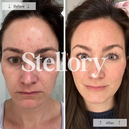 (VIP) Stellory® Red Light Therapy Mask - Rejuvenate Your Skin