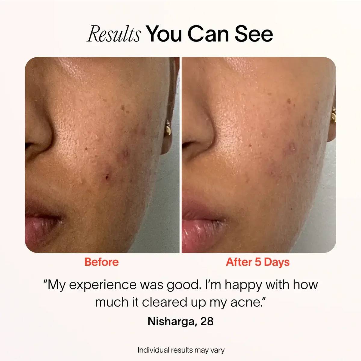 (VIP) Stellory® 3-Minute Acne Spot Treatment