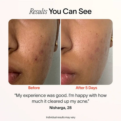 (VIP) Stellory® 3-Minute Acne Spot Treatment